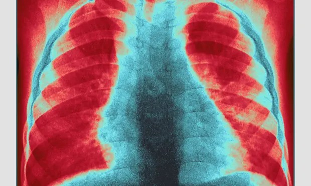 صورة بالأشعة السينية للجهاز التنفسي لطفل مصاب بعدوى الحصبة (غيتي)